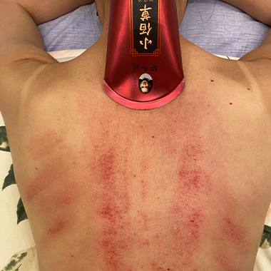 黃飛鴻小佰草抑菌液刮痧案例